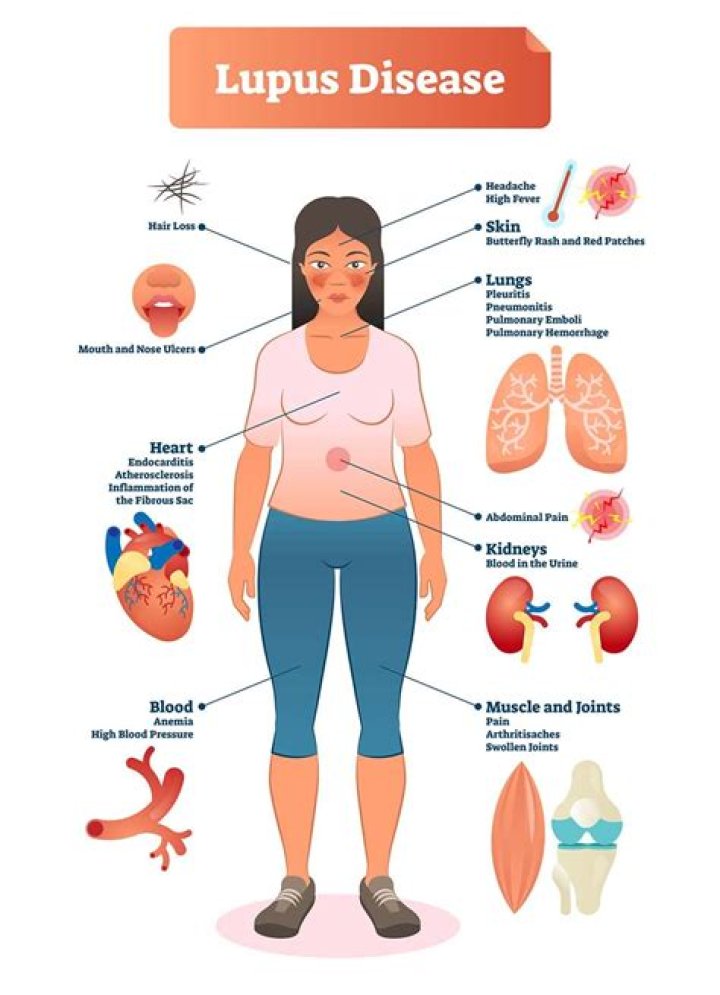 What are the signs and symptoms of lupus?