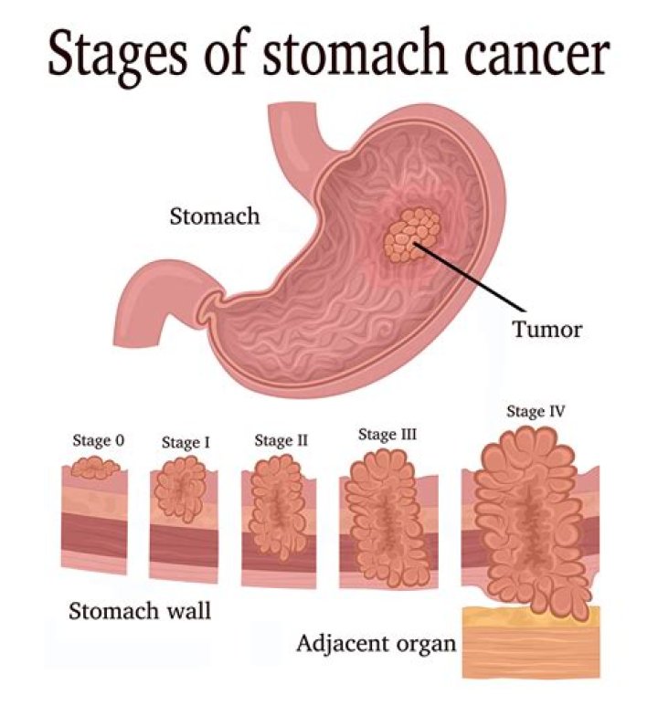 What are the two types of gastric carcinoma?
