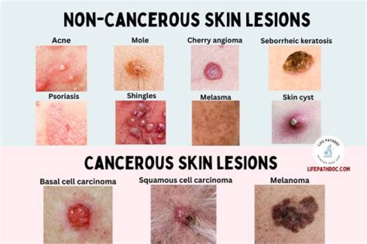 What are the types of skin lesions?