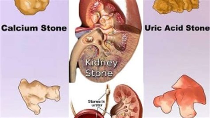 What are urinary stones made of?