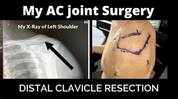 What can I expect after distal clavicle excision?