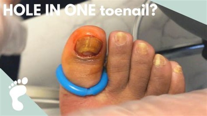 What causes a hole between your toes?