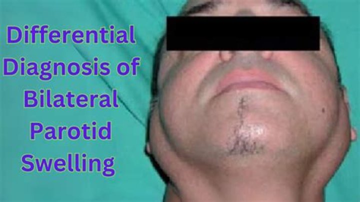 What causes bilateral parotitis?