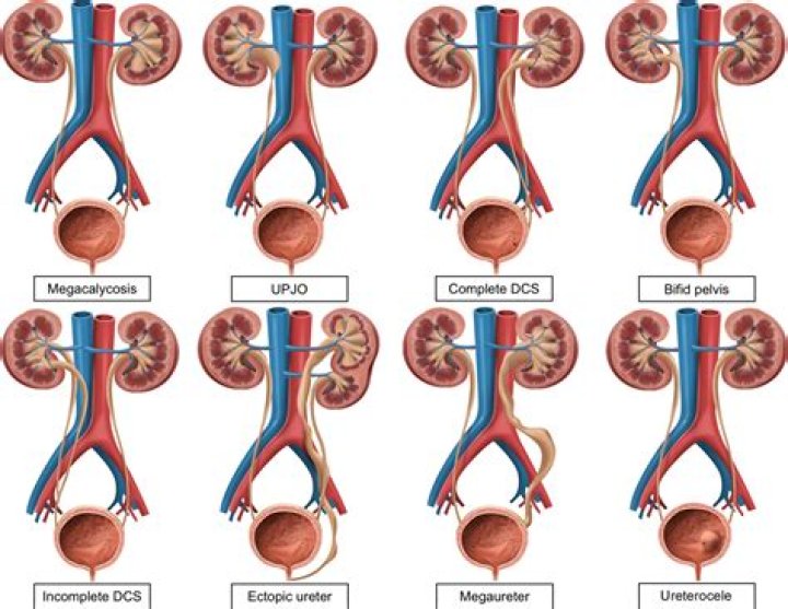 What causes ectopic ureter?