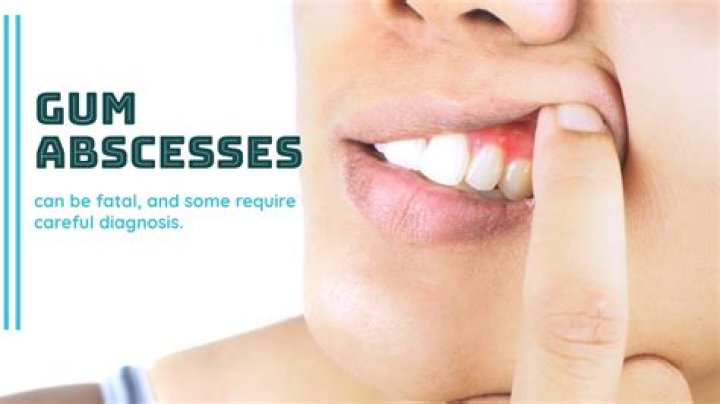 What causes gum polyps?