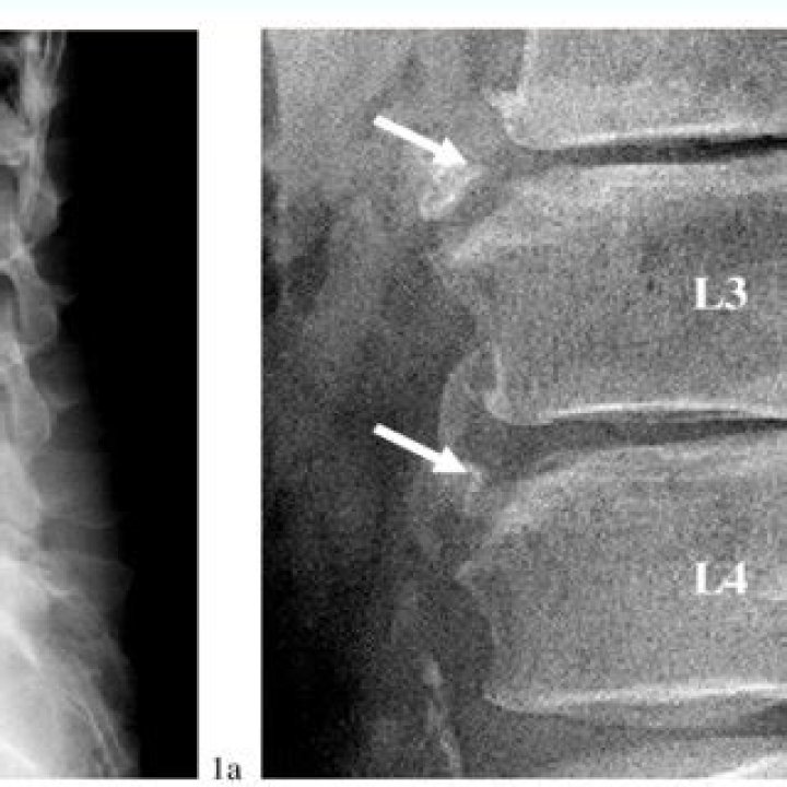 What causes limbus vertebra?