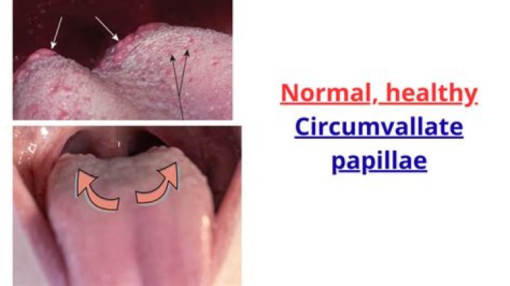 What causes overgrowth of papillae?