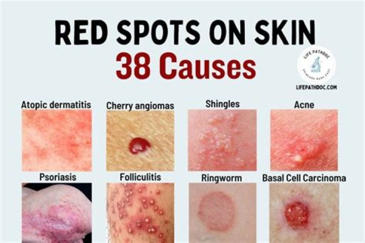 What causes red sores on the body?
