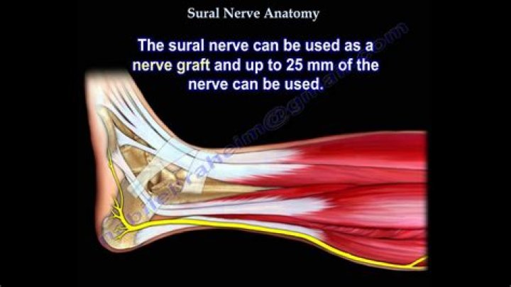 What causes sural nerve neuropathy?