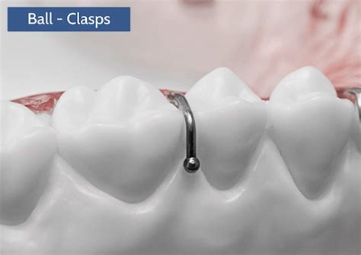 What clasp are utilized in an orthodontic retainer?