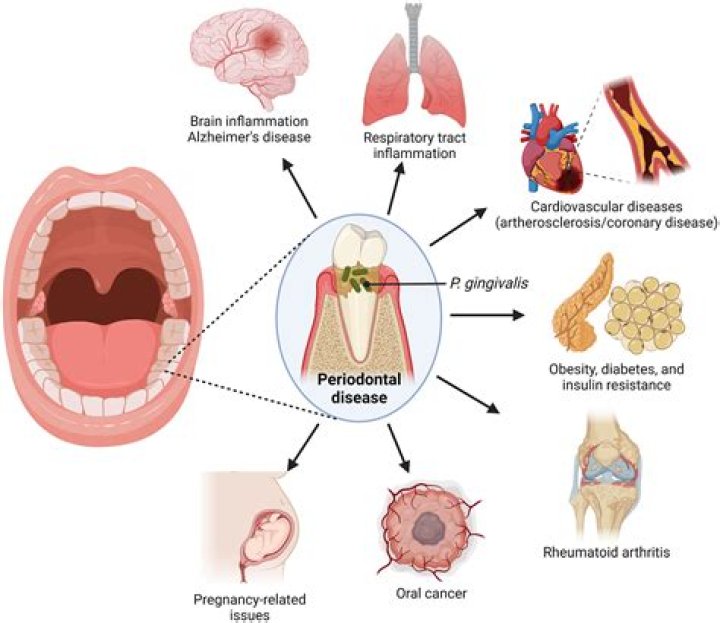 What disease does Porphyromonas gingivalis cause?
