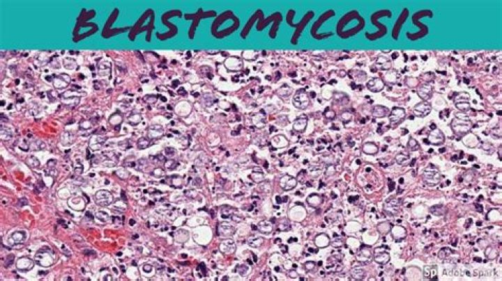What do blastomycosis lesions look like?