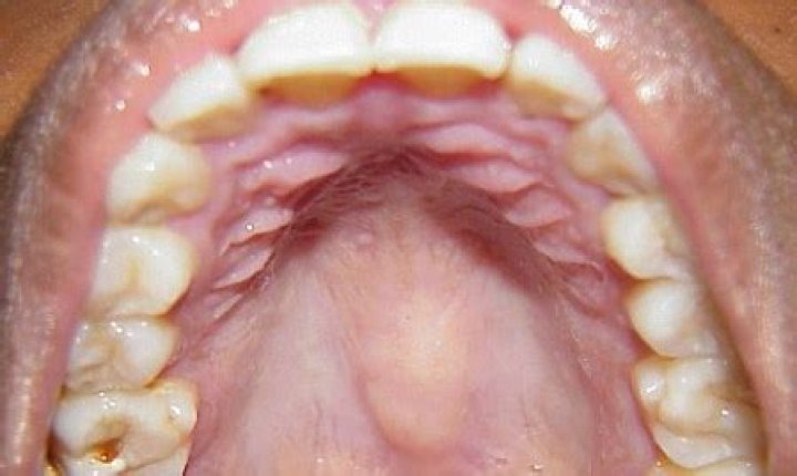 What do bumps on the back of your tongue mean?