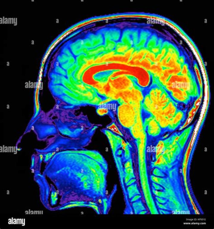 What do colors on brain MRI mean?