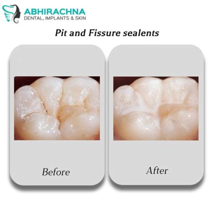 What do fissure sealants look like?