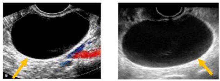 What does a hemorrhagic ovarian cyst look like on ultrasound?