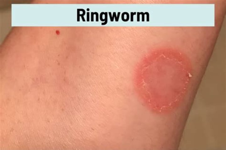 What does a red circle rash mean?