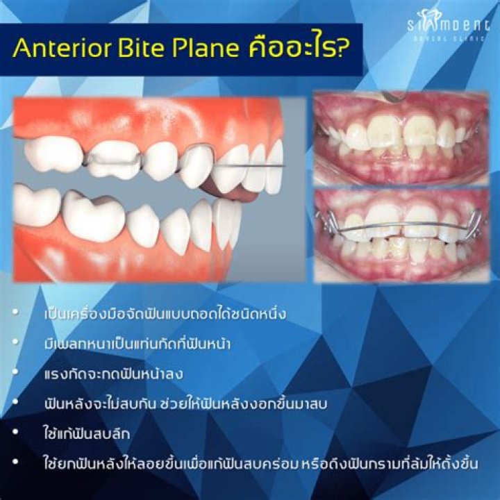 What does an anterior bite plate do?