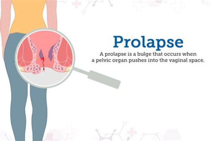 What does an internal prolapse feel like?