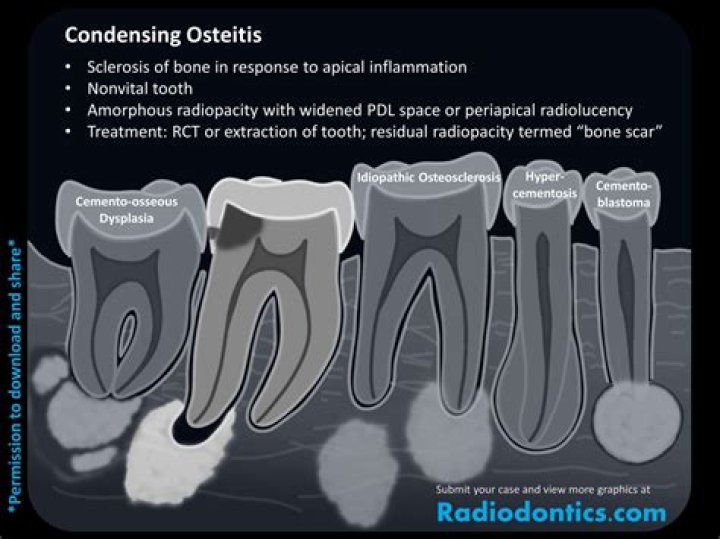 What does condensing osteitis mean?