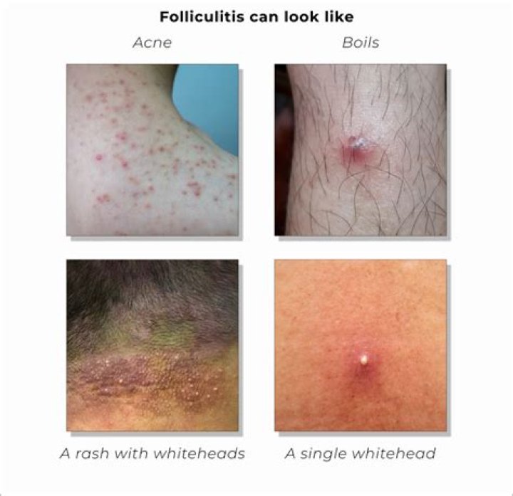 What does folliculitis look like on pubic area?