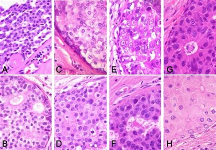 What does high nuclear grade DCIS mean?