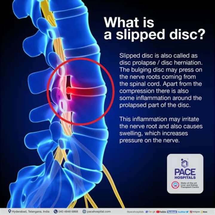 What does it feel like when you have a slipped disc in your back?