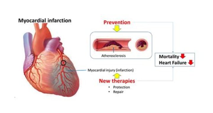 What does it mean to have infarcted myocardial tissue?