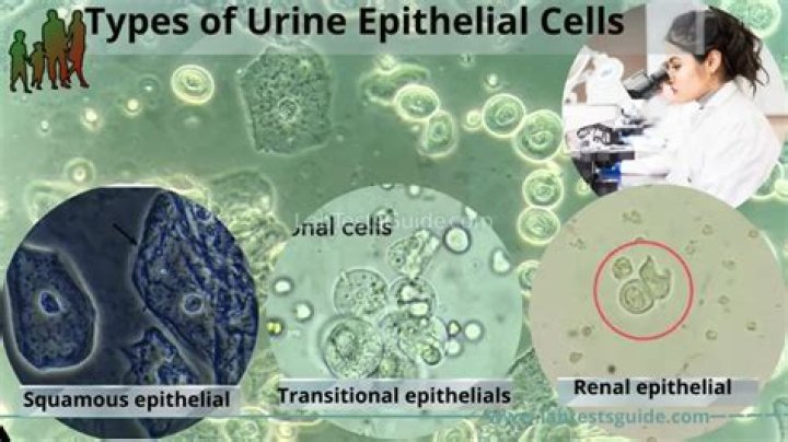 What does it mean when you have epithelial cells in your urine?