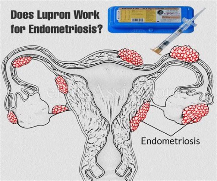 What does Lupron do for endometriosis?