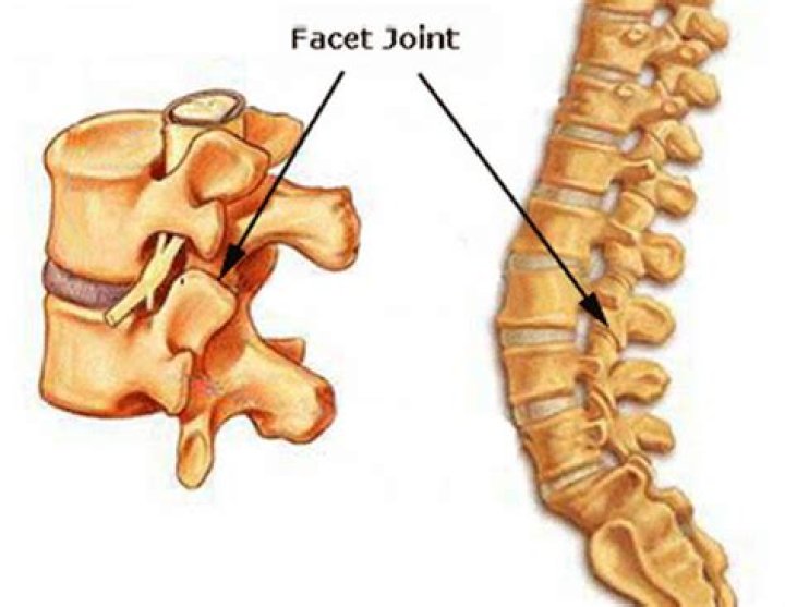 What does moderate bilateral facet arthropathy mean?
