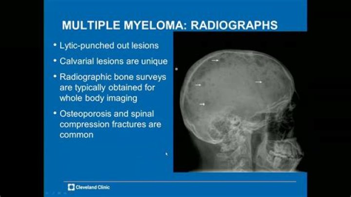 What does multiple myeloma look like on xray?