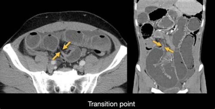 What does narrowing of the bowel mean?