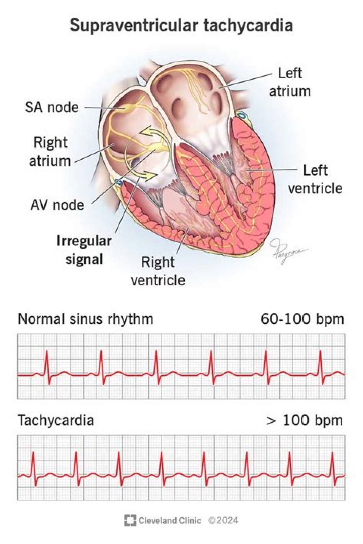 What does sinus tachycardia with PVCs mean?