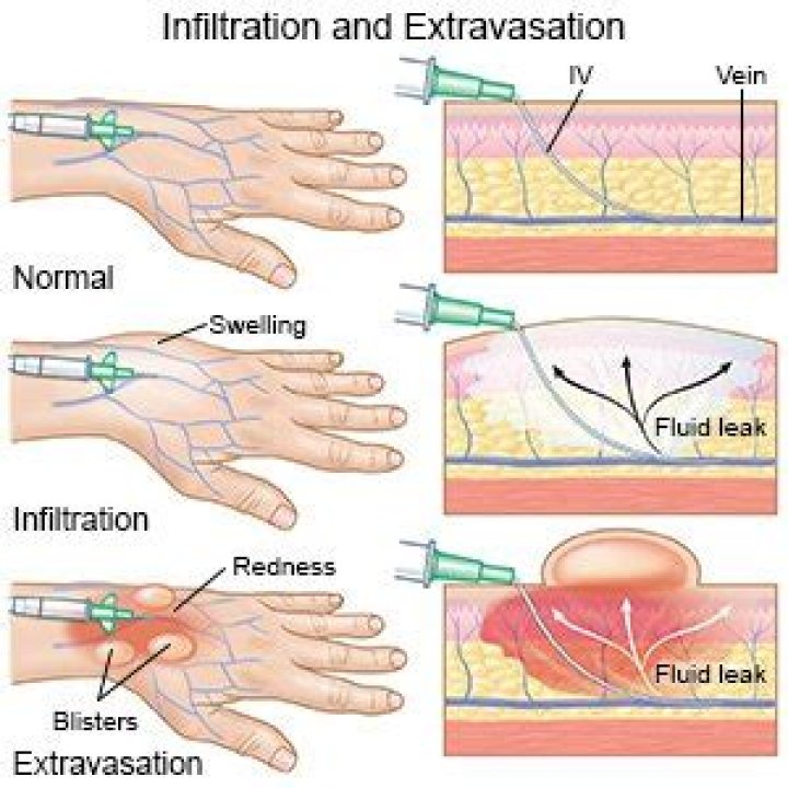 What drugs cause infiltration?