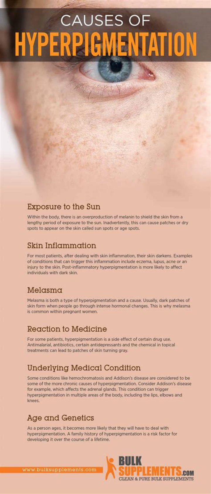 What endocrine disorder causes hyperpigmentation?