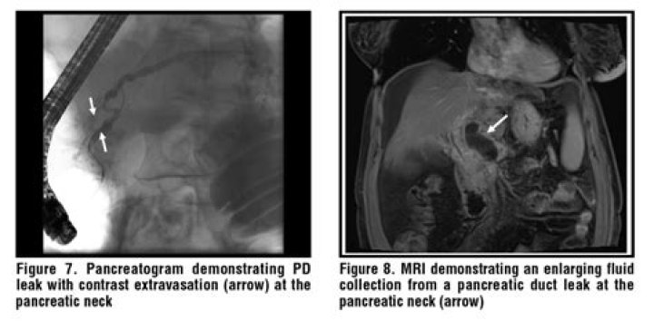 What happens if pancreatic fluid leaks?