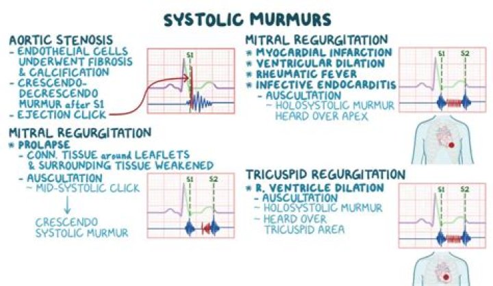 What is a 2 6 ejection systolic murmur?