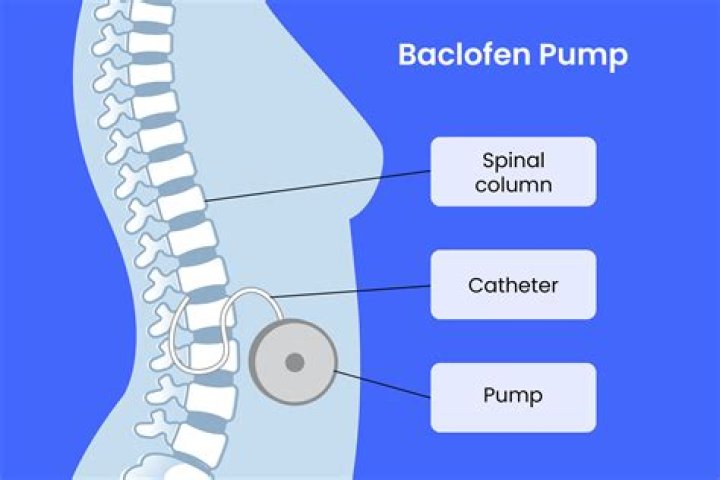 What is a baclofen pump and how does it work?