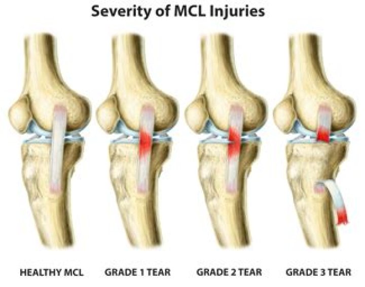 What is a Grade 1 MCL injury?