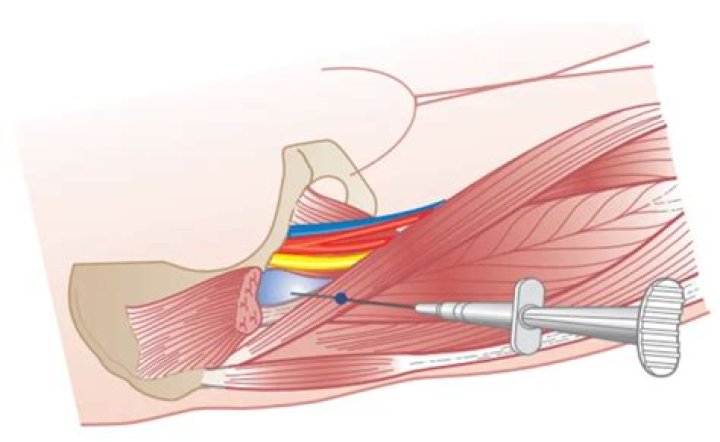 What is a iliopsoas injection?