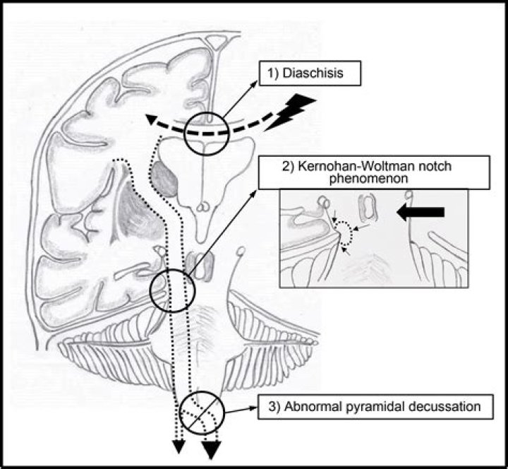 What is a kernohan notch?