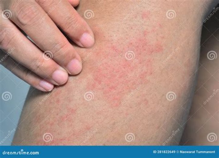 What is a red rash that burns?