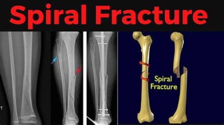 What is another name for spiral fracture?