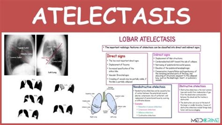 What is Atelectatic ear?