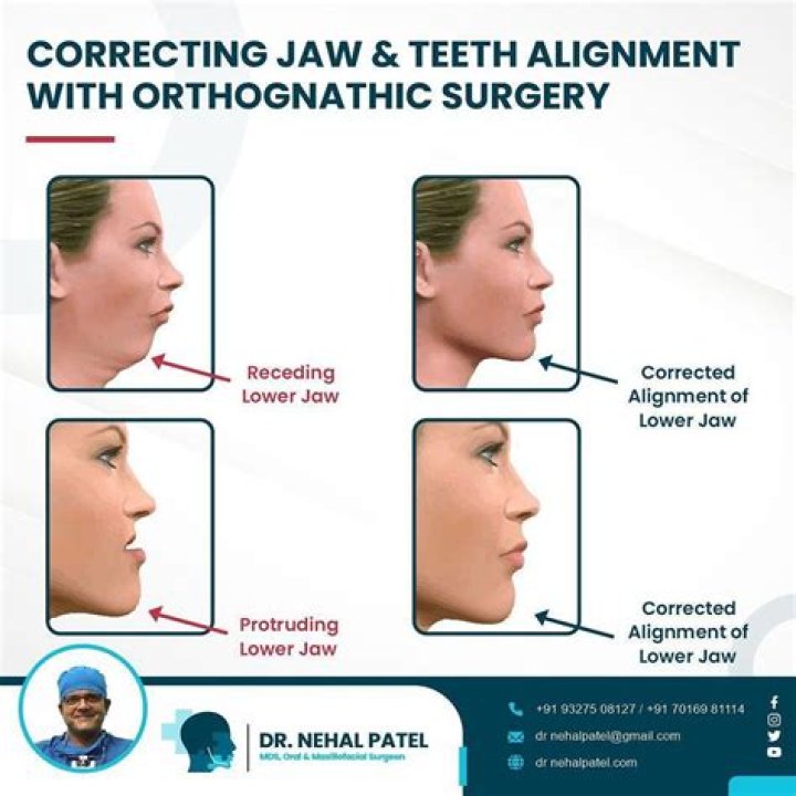 What is facial prognathism?