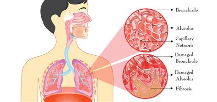What is fibrosis of a gland?