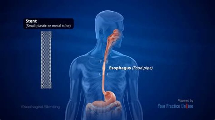 What is good for esophageal reflux?