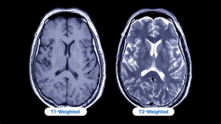 What is high signal on T1 MRI?