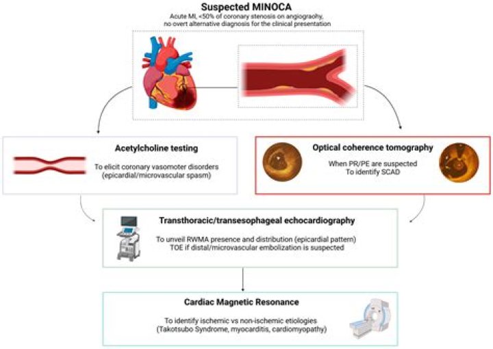 What is non-obstructive CAD?